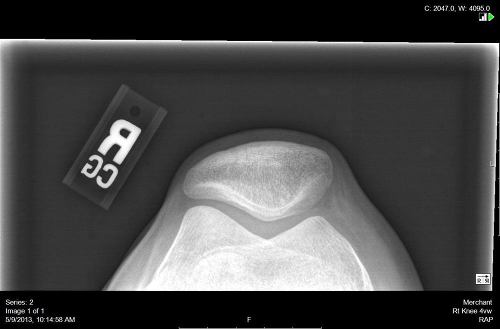Idiopathic Chondromalacia Patellae Knee & Sports Orthobullets